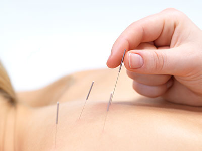 Acupuncture in Preston
